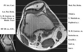 The muscles that affect the knee's movement run along the thigh and calf. Normal Mr Imaging Anatomy Of The Knee Magnetic Resonance Imaging Clinics