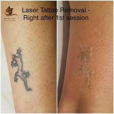 Laser tattoo removal program overview. 2 Day Laser Tattoo Removal Training Course Minnesota Brow Lash Studio Academy