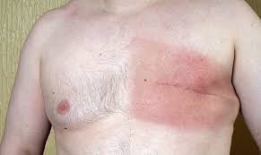 To be similar in appearance to; Breast Cancer In Men Do Men Have Breast Cancer
