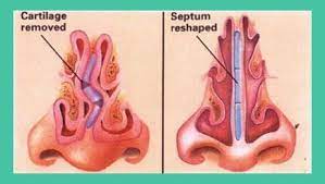 Getting Rid Of Stubborn Acne On Nose Pimple Inside Nose How To Pop A Pimple On Your Nose How To Get Rid Acne On Nose Nose Pimples Pimple Inside Nose