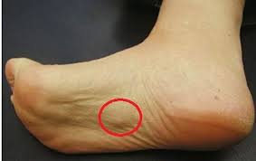 In the case of permitted digital reproduction, please credit the national cancer institute as the source and link to the original nci product using the original product's. Plantar Fibromatosis Aka Ledderhose Disease Foot Pain Explored