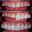 Veneers Treatment product image