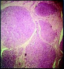 Merkel cell carcinoma most often develops in older people. Jcdr Eccrine Porocarcinoma Histopathology Malignant Tumor Scalp