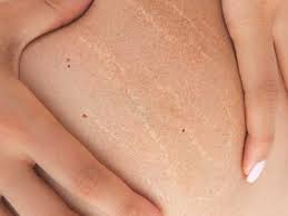 Check spelling or type a new query. Do Stretch Marks Go Away