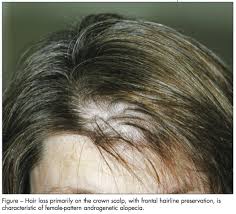 Hormone therapies can trigger hormone imbalances in women, causing hair loss — and potentially causing permanent female pattern baldness. Woman With Progressive Hair Loss Consultant360