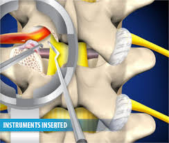Pin On Misi Spine Treatments