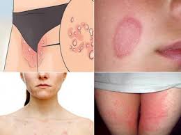 Try These Home Remedies To Cure Ringworm Newstrack English 1