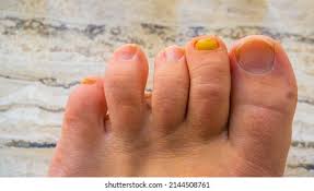 Image result for Yellow nail syndrome feet