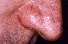 Infection bactérienne, anomalie des vaisseaux sanguins, problème sanguin. Laser Vasculaire Pour Traiter Les Vaisseaux Jambes Visage Et Nez A Martigues Centre Jouvence