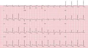 An nstemi differs from a stemi, which is the most common type of heart attack, by causing less damage to a. Non St Elevation Myocardial Infarction Diagnosis And Management Intechopen