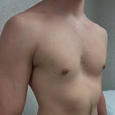 Image result for Pectus Excavatum