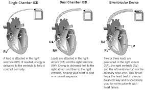 Implantable cardioverter defibrillators (icds) are indicated to provide ventricular antitachycardia pacing and ventricular defibrillation for automated treatment of. Implantable Cardioverter Defibrillator Icd Treatment Outlook