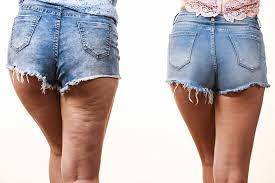 cellulite wie sie entsteht was dagegen hilft phytodoc