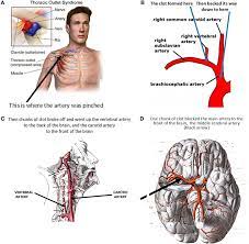 Big Surprise The Brain Can Recover Many Years After A Stroke Frontiers For Young Minds