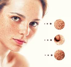 Acne can be a painful and embarrassing skin condition, and the scars it leaves behind are an unwelcome reminder of that. Howto How To Get Rid Of Acne Scars Fast