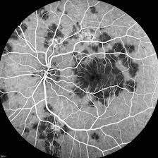 The most common complaint is transient acute central or paracentral vision loss. August 2013