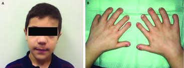 A. Extraoral vision, B. Intraoral vision: Polidactyly in both hands, as... 