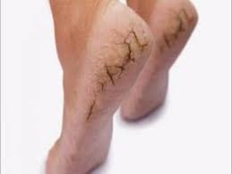 Rasa tak selesa dan malu nak pakai selipar.. Petua Hilangkan Rekahan Pada Tumit Kaki