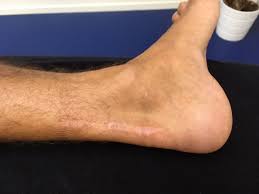 Blog 14 Revalidatie Na Een Scheur Van De Achillespees Opereren Of Niet Peescentrum Groningen Fysiotherapie