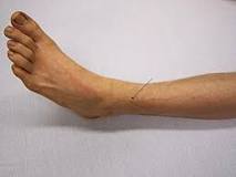 Lightning injury - Wikipedia