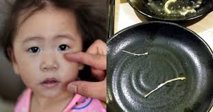 Toddler Chokes On 5cm Fish Bone In Kid S Meal Food Singapore News Asiaone