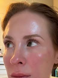 Patient 1, My Mom. She's a great sport and always gives me freedom. Happy  Birthday and Merry Christmas! Mom suffered extensive volume loss following  the usage of GLP-1s. I treated her with