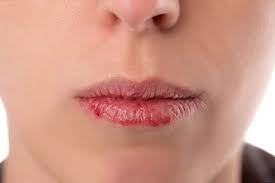 Die lippen schwellen normalerweise aufgrund von traumata oder allergien an. Cheilitis Ursachen Symptome Behandlung Medlexi De