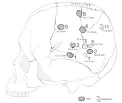 Burzahom archaeological site is located about 10 km northeast of srinagar in the kashmir valley. Sketch Of The Trepanated Skull Of Burzahom Showing The Attempted And Download Scientific Diagram