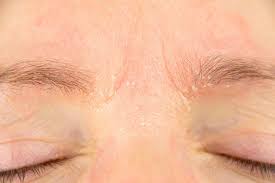 Pruritis or itchy skin is tingling or irritation that makes you want to scratch the area. Itchy Face And Skin Rashes Bepanthen