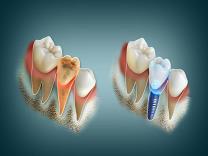 Dental Implant (Missing Tooth Solution) product image