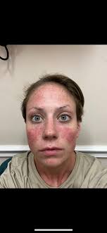 I had this happen to me a year ago this week. All tests came back negative.  Still trying to figure out what happened here. I have and had all of the  physical