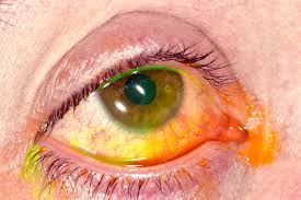 Image result for Eye Foreign Body
