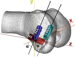 An fcl is commonly injured due to a blow to the inside of the knee. Multiple Ligament Reconstruction Femoral Tunnels Intertunnel Relationships And Guidelines To Avoid Convergence Jorge Chahla Md Jorge Chahla Md