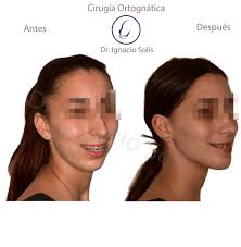 Cirugia Ortognatica