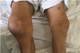 Neuroartropat&iacute;a de Charcot: Diagn&oacute;stico diferencial de monoartritis de  rodilla en pacientes con diabetes mellitus 2