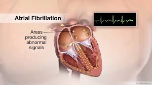 Image result for Atrial Fibrillation