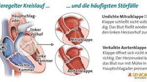 Ersetzen Oder Reparieren Wenn Die Ventile Des Herzens Schlapp Machen Welt