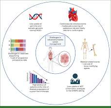 Image result for Prostate Cancer Management