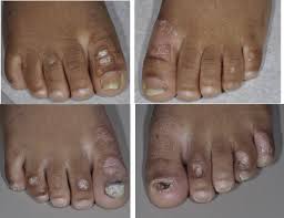 Image result for Onychotillomania feet