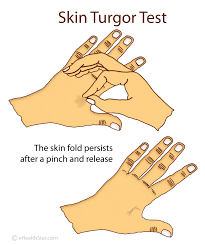 Normal And Poor Skin Turgor Definition Assessment Scale