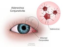 Image result for Viral Conjunctivitis