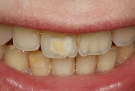 But have you ever heard of white spots on teeth? What Are White Spots On Teeth And 10 Ways To Get Rid Of Them Smart Teeth Whitening