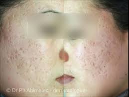 Å gå på antiobiotika høres ikke bra ut og så ille er ikke mitt tilfelle i så fall, men sliter med mye kviser og jeg plukker på dem slik at de blir sår, men ellers hvis man skal kjøpe krem for huden og kviser kontakt lege eller gå på. Akne Arr Laserbehandling Oslo Hudlegesenter