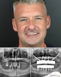🦷 A New Success Story with Zygomatic Implants! In some cases, traditional  dental implants simply aren't possible… But for us, that's never the end of  the story — it's just the beginning.