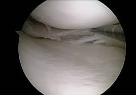 However, over 2 to 3 days, your knee will gradually become more stiff and swollen. Can I Make A Meniscus Tear Worse If I Run On It Howard J Luks Md