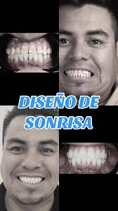 Diseño de Sonrisa 🦷 . Diseño de Sonrisa a cargo de Dra Mayra Álvarez,  @mayra.alvarz . Px con diagnóstico de Fluorosis, quien buscaba una  esperanza favorable para el cambio de su sonrisa. Eliminación ...
