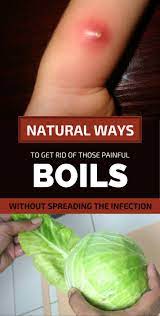 Natural Ways To Get Rid Of Those Painful Boils Without Spreading The Infection Boil Remedies Get Rid Of Boils Health Remedies