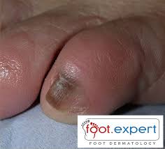 Image result for Onychotillomania feet