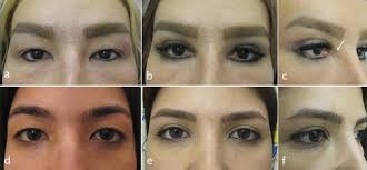 Full article: Upper blepharoplasty: advanced techniques and adjunctive  procedures