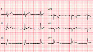Taquicardia sinusal, ectopia ventricular • biópsia→ se suspeita de sarcoidose ou miocardite de células gigantes em doentes com rápida. Http Www Codajic Org Sites Www Codajic Org Files Miopericardite 20aguda 20no 20adolescente 20 E2 80 93 20dois 20casos 20cl C3 Adnicos Pdf